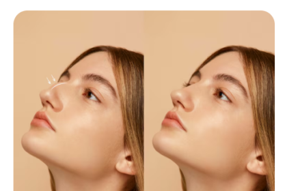 buccal fat removal before and after